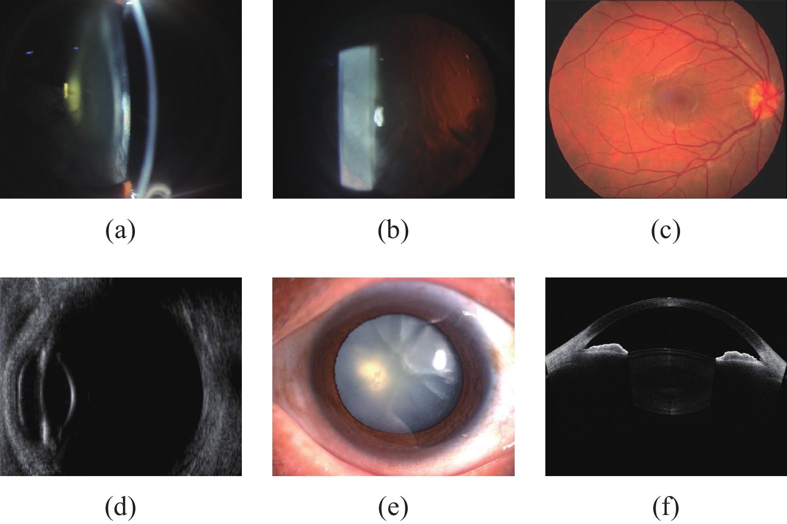 Types Of Cataracts On Slit Lamp Types Of Cataracts On Slit Lamp