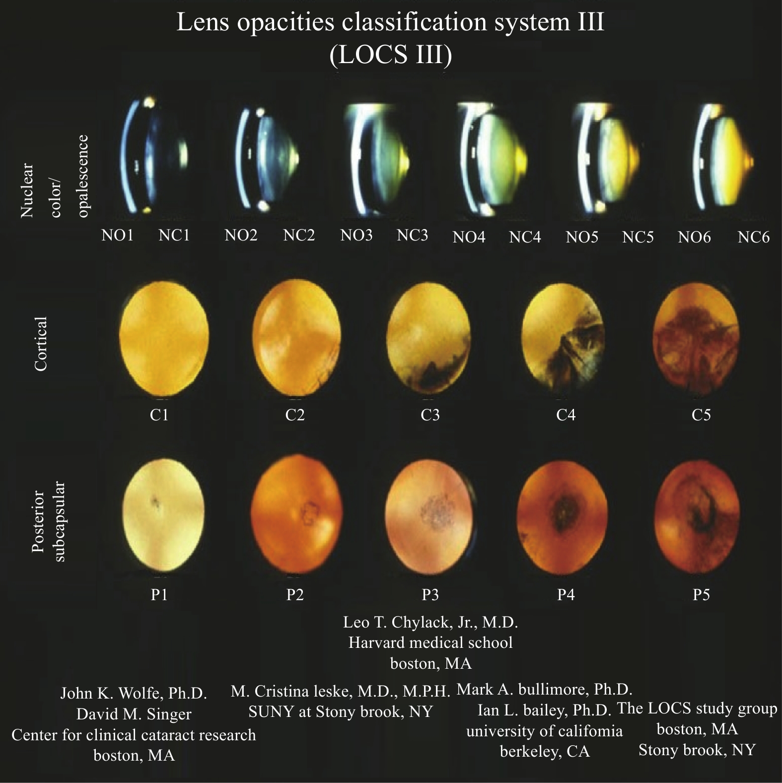 Posterior Subcapsular Cataract Grading Posterior Subcapsular Cataract Grading